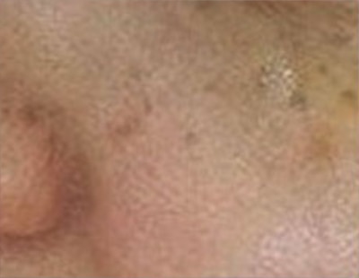 Skin spot types 1