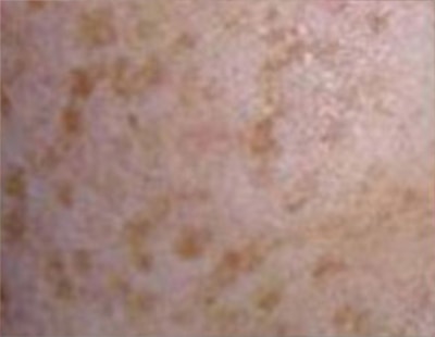 Skin spot types 2