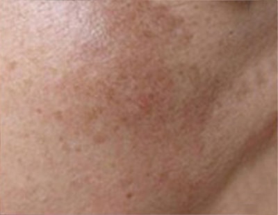Skin spot types 3