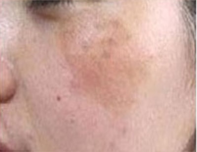 Skin spot types 4