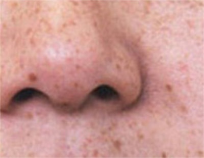 Skin spot types 5
